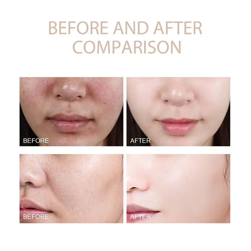 Exfoliating Gel forAcanthosis Nigricans,Focus on creating softand radiant skin